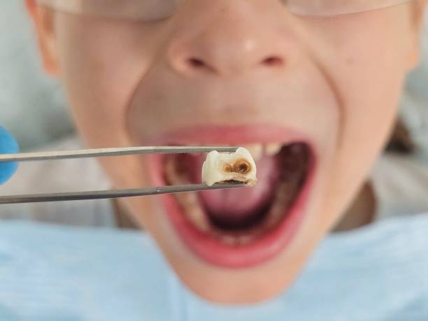 Best Emergency Dental Extractions in Grand Blanc, MI
